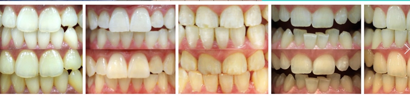 Teeth Whitening in Sorrento and Salmon Arm, BC